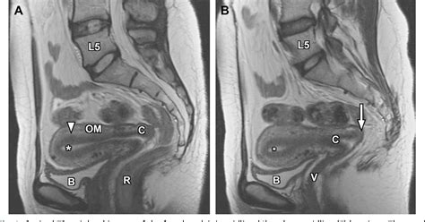 Magnetic resonance imaging of male and female genitals during。